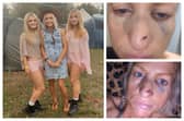 Ciara Lawlor with her daughters at Electric Picnic and after her fall. 