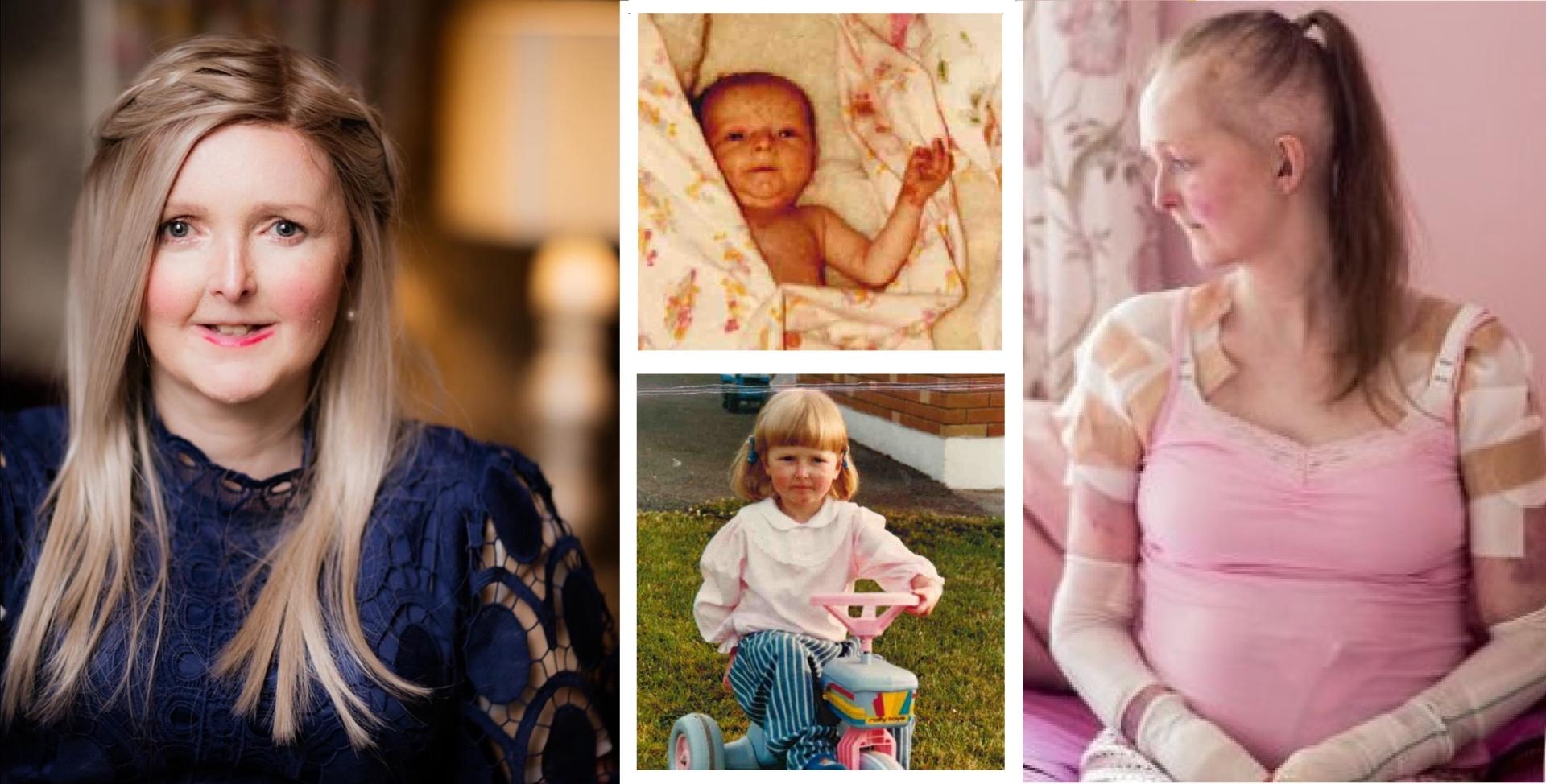 Laois EB patient Emma Fogarty has one wish for her 40th birthday - Laois  Live