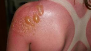  Dublin midlands hospital treating people for serious sunburn and other heatwave ailments