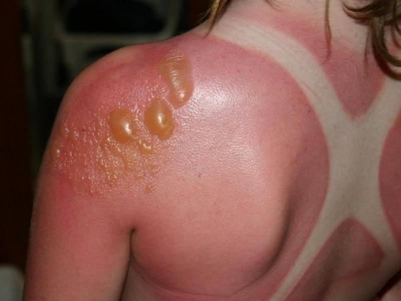 Be careful in the sun or this could happen you