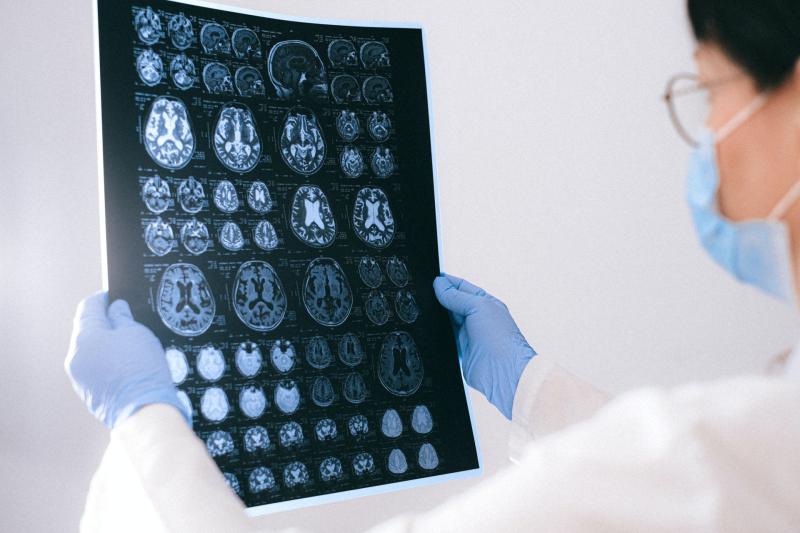 New technology developed to predict early Alzheimer's
