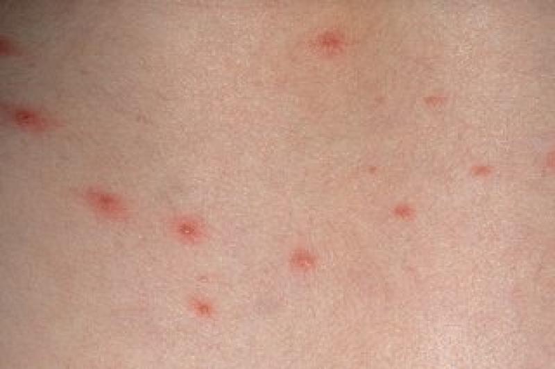 HIQA asks Irish parents to have their say on adding chicken pox jab to vaccine schedule