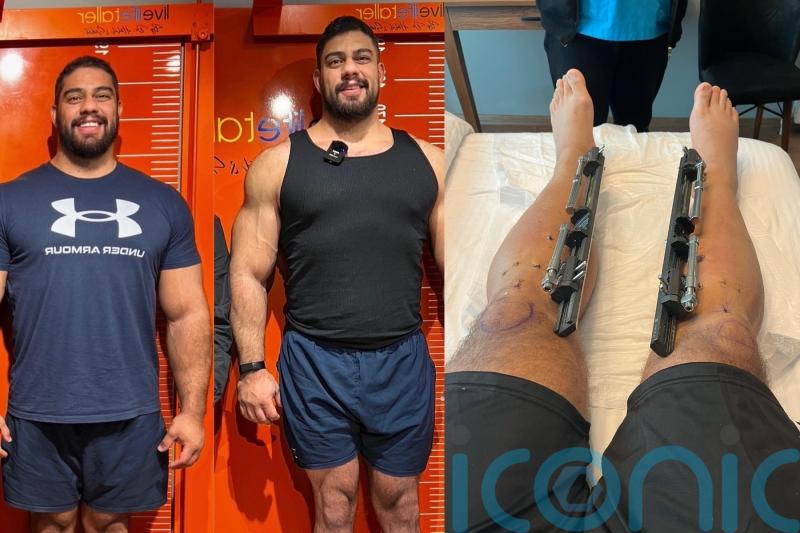 Dad of two spends €100k lengthening his limbs to increase height from 6ft to 6ft 7in